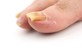EmoniNail™ kills nail fungus in Chelsea - New York, NY Beauty Treatments