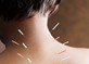 Traditional Chinese Acupuncture and Acupressure in Tulsa, OK Acupuncture Clinics