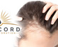 Concord Hair Restoration in Mission Valley - San Diego, CA Hair Care & Treatment