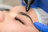 Fibroblast Plasma Pens San Jose in Downtown - San Jose, CA