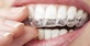 Las Vegas Invisalign in Las Vegas, NV Dentists