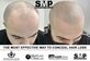 smp tattoo in New York, NY Hair Replacement & Extensions