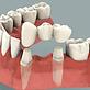 Tooth Implant NYC in Murray Hill - New York, NY Dentists