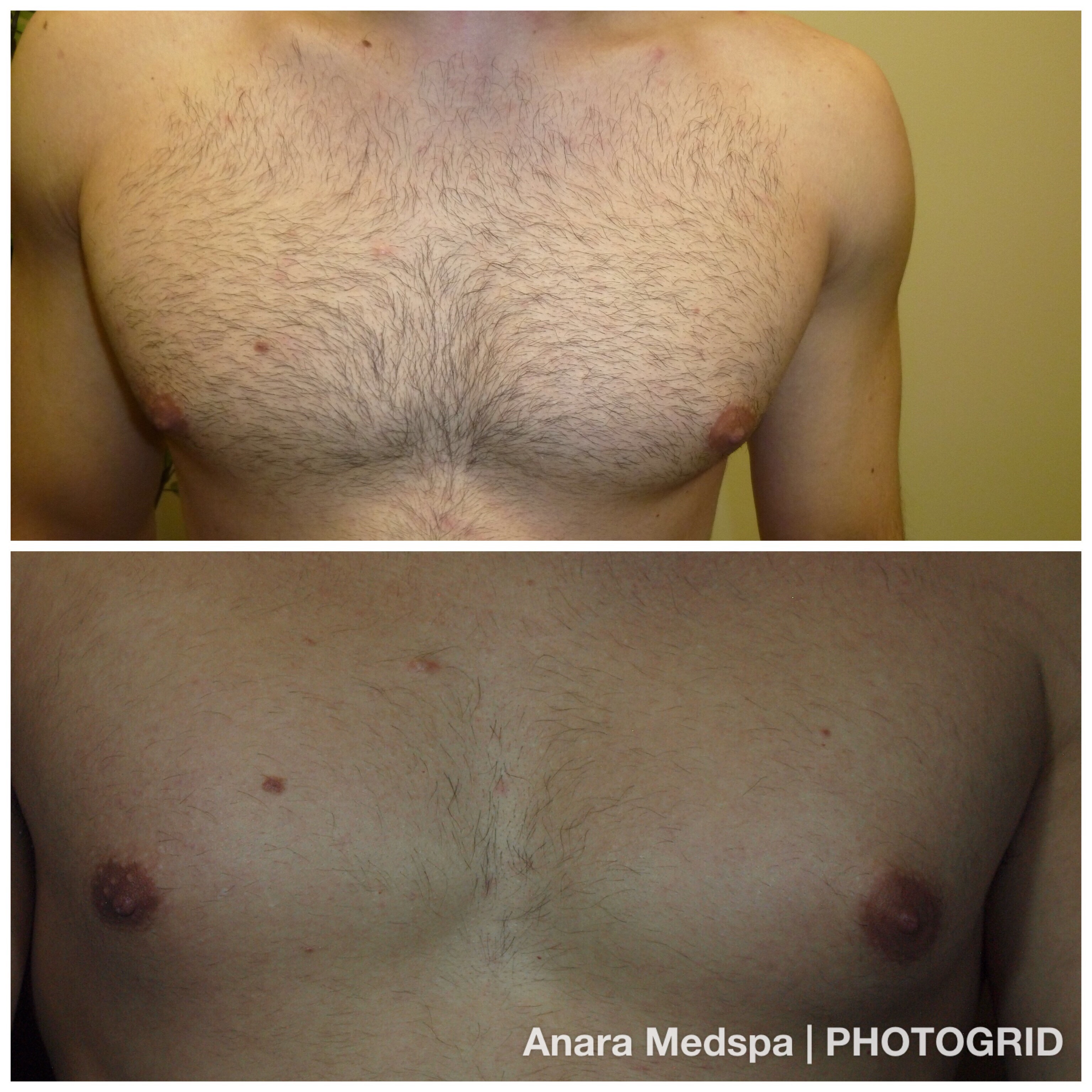 15% off single laser hair removal session for any area