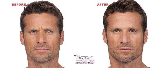 Product: BOTOX® Cosmetic is the only approved treatment to temporarily improve the appearance of both moderate to severe frown lines between the brows and crow’s feet lines in adults. - Neoderma in Anaheim, CA Health & Medical