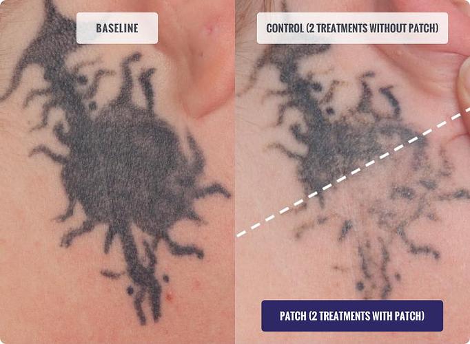 Product: The Patch allows up to 4x as many passes in each treatment session versus without the Patch - Neoderma in Anaheim, CA Health & Medical