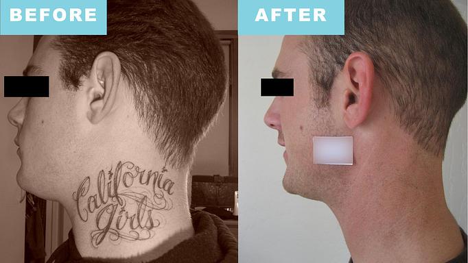 Product: Actual patient. Brian received laser tattoo removal treatment for the removal of a neck tattoo. - Neoderma in Anaheim, CA Health & Medical