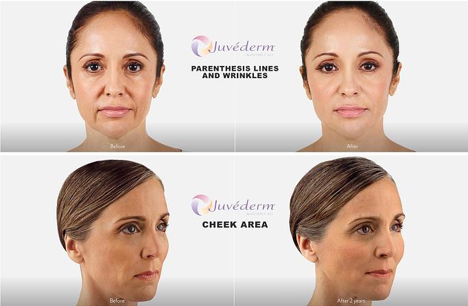 Product: Everyone will notice. No one will know. Lift, smooth, or plump your way to subtle results that last. - Neoderma in Anaheim, CA Health & Medical