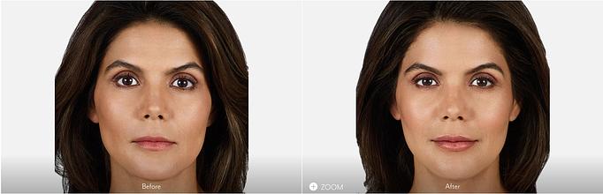 Product: Lips: Fill and Smooth. JUVÉDERM VOLBELLA® XC adds volume to the lips and smooths vertical lip lines. - Neoderma in Anaheim, CA Health & Medical