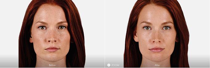 Product: Lips - Plump. JUVÉDERM® Ultra XC adds fullness to the lips for up to 1 year with optimal treatment. - Neoderma in Anaheim, CA Health & Medical
