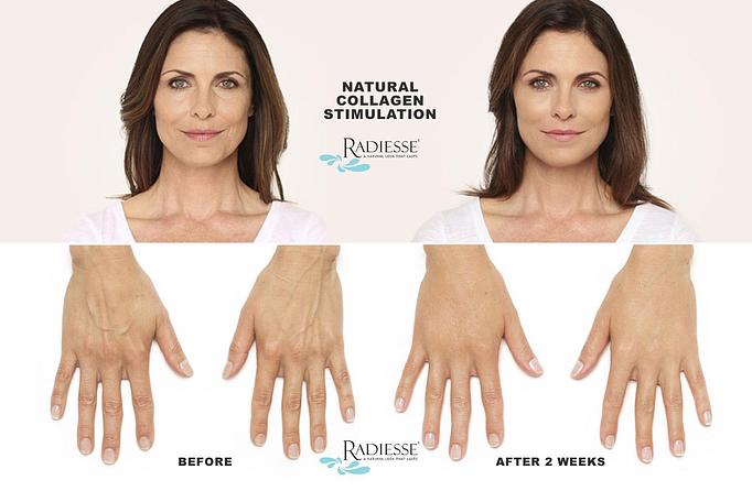 Product: Natural Collagen Stimulation for Face and Hands. (Hands Treatment volume: 1 syringe (1.5 cc) per hand. Individual results may vary. Unretouched photos of actual patient.) - Neoderma in Anaheim, CA Health & Medical