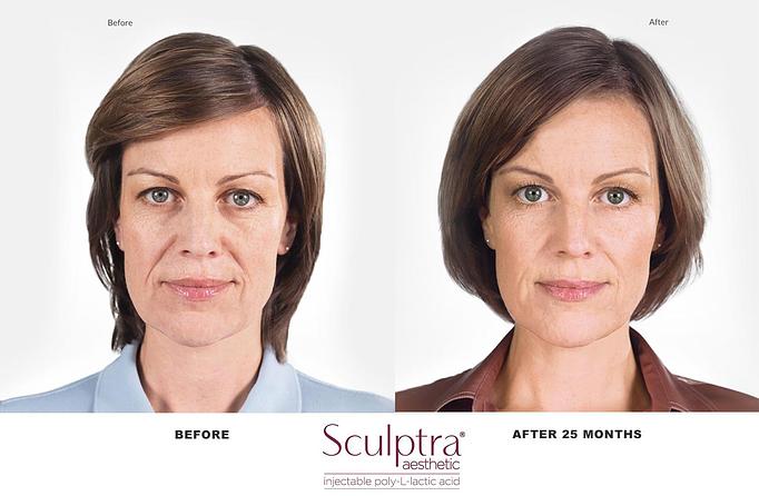 Product: Franca: Age 42
Real Sculptra Aesthetic patient

25 months after first treatment. Individual results may vary. - Neoderma in Anaheim, CA Health & Medical