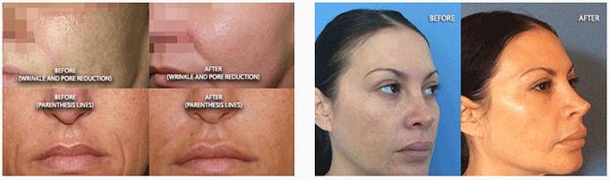 Product: Do you want to know the secret to anti-aging? If you want to reduce acne scars, fine lines or wrinkles, and improve your skin's appearance with zero downtime this is for you. - Neoderma in Anaheim, CA Health & Medical