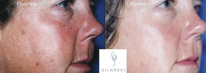 Product: NO DOWNTIME
NON-INVASIVE
FULLY CUSTOMIZABLE TO TREAT A VARIETY OF SKIN CONDITIONS
TREATS ALL SKIN TONES - Neoderma in Anaheim, CA Health & Medical