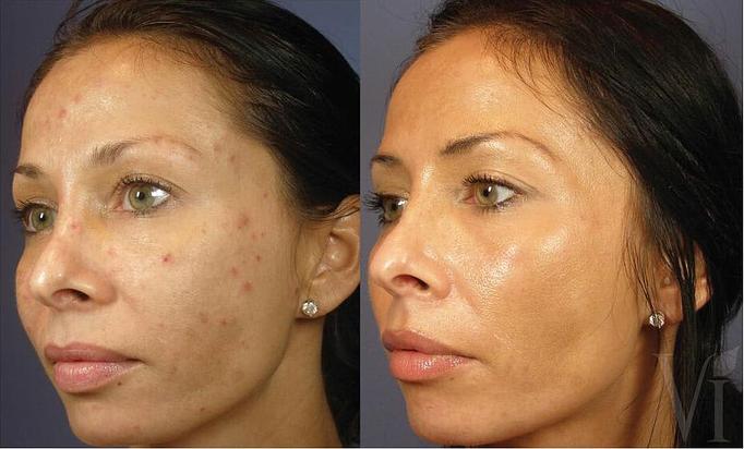 Product: Discover the VI Peel, the painless chemical peel, to address a variety of skin concerns including anti-aging, pigmentation and acne. - Neoderma in Anaheim, CA Health & Medical