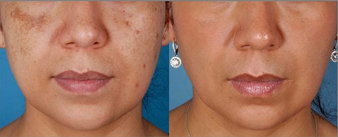 Product: This patient received: ZO Multi-therapy Hydroquinone system for 5 months, followed by ZO Non-Hydroquinone hyperpigmentation system for 1 month, and as ongoing maintenance. ZO 3 Step Peel performed monthly for 3 months. - Neoderma in Anaheim, CA Health & Medical