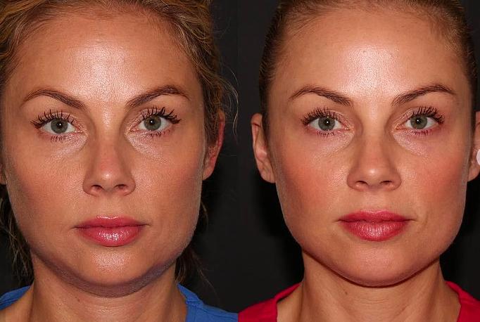 Product: Kybella (Chin Fat Treatment) - Zen Aesthetics and Wellness in Sycamore Square - Edmond, OK Day Spas