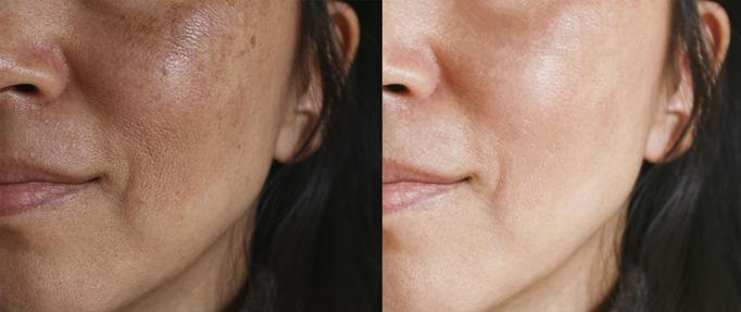 Product: Chemical Peels Range from Mild to MD peels. - Zen Aesthetics and Wellness in Sycamore Square - Edmond, OK Day Spas