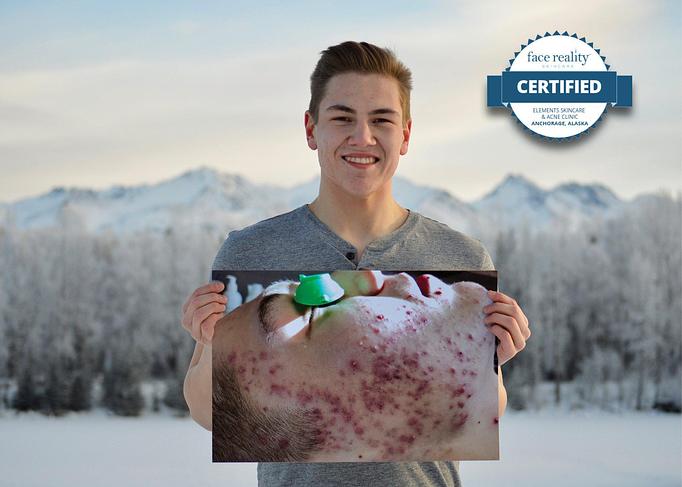 Product: Acne Skin Care - Somatic Massage Therapy, P.C in Floral Park - Floral Park, NY Massage Therapy