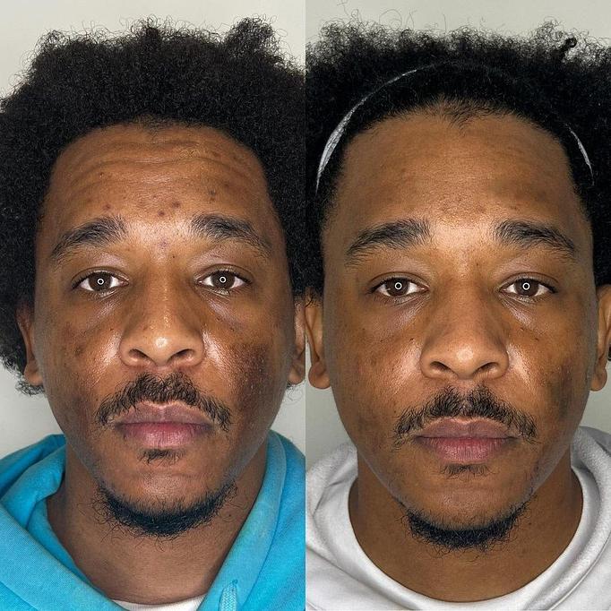 Product: VI Peel - Somatic Massage Therapy, P.C in Floral Park - Floral Park, NY Massage Therapy