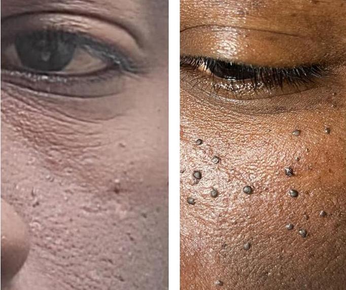 Product: Skin Tag Removal - Somatic Massage Therapy, P.C in Floral Park - Floral Park, NY Massage Therapy