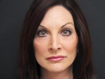 Product: After Anterior Lift and Lower Blepharoplasty - Beaches Facial Plastic & Nasal Surgery Center in Jacksonville Beach, FL Physicians & Surgeons Plastic Surgery