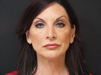 Product: Before Anterior Lift and Lower Blepharoplasty - Beaches Facial Plastic & Nasal Surgery Center in Jacksonville Beach, FL Physicians & Surgeons Plastic Surgery