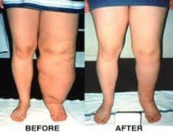 Product - Gateway Center Massage and Lymphedema Care in Staten Island, NY Hospitals