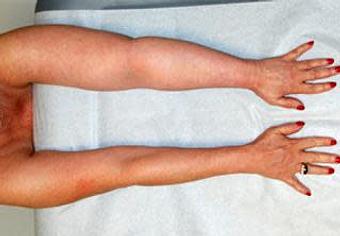 Product - Gateway Center Massage and Lymphedema Care in Staten Island, NY Hospitals