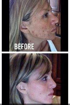 Product: UNBLEMISH  regimen for acne and post acne marks - Gina Riley Skincare Specialist in Naperville, IL Rehabilitation Products & Services