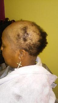 Product: Androgenetic Alopecia (Before Pic) - National Black Hair Institute in Tucker, GA Beauty Salons