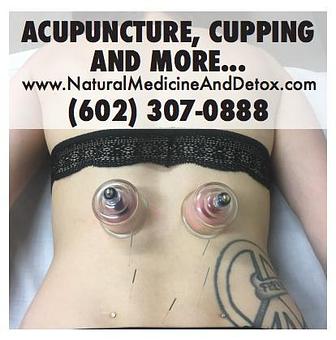 Product: acupuncture and cupping - Natural Medicine & Detox in Phoenix, AZ Health & Medical