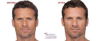 Product: BOTOX® Cosmetic is the only approved treatment to temporarily improve the appearance of both moderate to severe frown lines between the brows and crow’s feet lines in adults. - Neoderma in Anaheim, CA Health & Medical