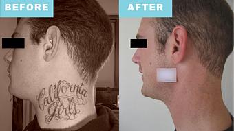 Product: Actual patient. Brian received laser tattoo removal treatment for the removal of a neck tattoo. - Neoderma in Anaheim, CA Health & Medical