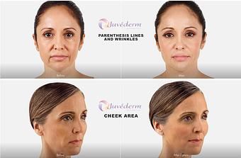 Product: Everyone will notice. No one will know. Lift, smooth, or plump your way to subtle results that last. - Neoderma in Anaheim, CA Health & Medical