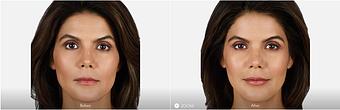 Product: Lips: Fill and Smooth. JUVÉDERM VOLBELLA® XC adds volume to the lips and smooths vertical lip lines. - Neoderma in Anaheim, CA Health & Medical