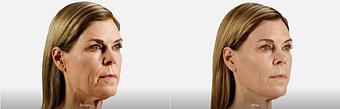 Product: JUVÉDERM VOLUMA® XC instantly adds volume to create a more youthful appearance for up to 2 years with optimal treatment. - Neoderma in Anaheim, CA Health & Medical