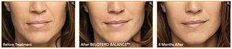 Product: Lisa / Age 44

Lisa received treatment directed at moderate vertical lip lines above and below her lips, and etched-in smile lines around her mouth. - Neoderma in Anaheim, CA Health & Medical