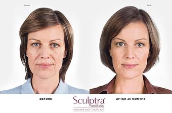 Product: Franca: Age 42
Real Sculptra Aesthetic patient

25 months after first treatment. Individual results may vary. - Neoderma in Anaheim, CA Health & Medical