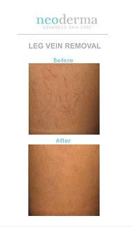 Product: Sclerotherapy is a minimally invasive procedure to treat uncomplicated spider veins and uncomplicated reticular veins. The treatment involves the injection of a solution into the affected veins. - Neoderma in Anaheim, CA Health & Medical