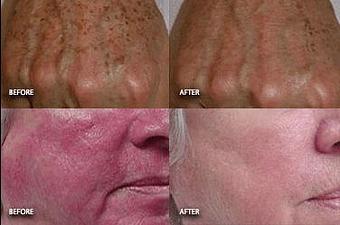 Product: Clinically proven to effectively treat acne, rosacea, thread veins, fine lines/wrinkles, and the visible signs of sun damage/dark spots, Photofacial treatments leave your skin looking smooth, silky and radiant. - Neoderma in Anaheim, CA Health & Medical