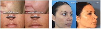 Product: Do you want to know the secret to anti-aging? If you want to reduce acne scars, fine lines or wrinkles, and improve your skin's appearance with zero downtime this is for you. - Neoderma in Anaheim, CA Health & Medical