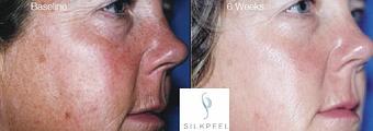 Product: NO DOWNTIME
NON-INVASIVE
FULLY CUSTOMIZABLE TO TREAT A VARIETY OF SKIN CONDITIONS
TREATS ALL SKIN TONES - Neoderma in Anaheim, CA Health & Medical