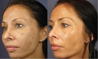 Product: Discover the VI Peel, the painless chemical peel, to address a variety of skin concerns including anti-aging, pigmentation and acne. - Neoderma in Anaheim, CA Health & Medical