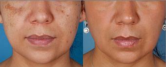 Product: This patient received: ZO Multi-therapy Hydroquinone system for 5 months, followed by ZO Non-Hydroquinone hyperpigmentation system for 1 month, and as ongoing maintenance. ZO 3 Step Peel performed monthly for 3 months. - Neoderma in Anaheim, CA Health & Medical