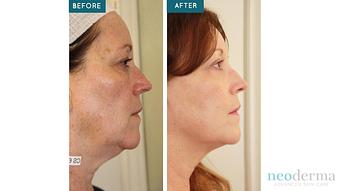 Product: Patient Connie: receive Viora skin tightening treatment for her neck, customized skin care and IPL to address uneven skin tone and texture - Neoderma in Anaheim, CA Health & Medical