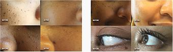 Product: Various skin growths can appear out of nowhere and blemish any complexion. At Neoderma, we use a simple and comfortable method to bring back the smoothness before the growths appeared. - Neoderma in Anaheim, CA Health & Medical