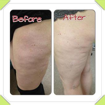 Product - Safe Laser Therapy in Stamford, CT Day Spas