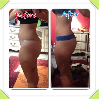 Product: body Contouring - Safe Laser Therapy in Stamford, CT Day Spas