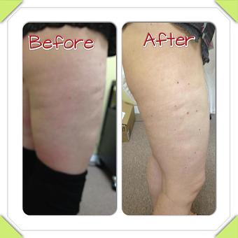 Product - Safe Laser Therapy in Stamford, CT Day Spas